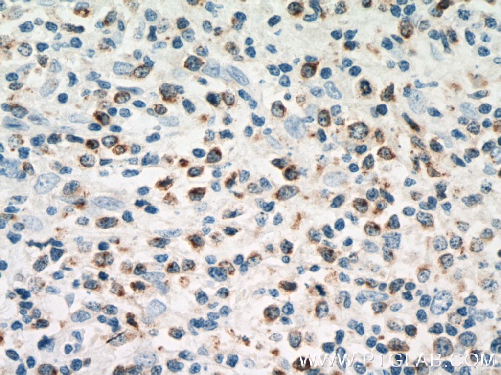 Immunohistochemistry (IHC) staining of human lymphoma tissue using RAB27A-specific Polyclonal antibody (16868-1-AP)