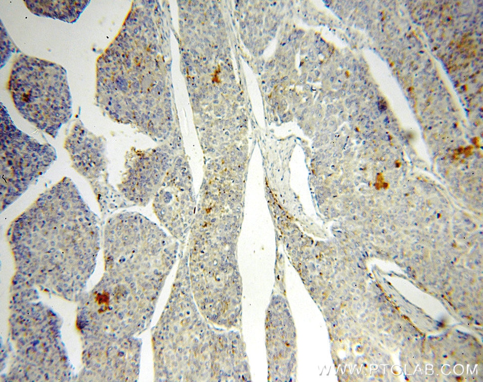 IHC staining of human liver cancer using 16868-1-AP