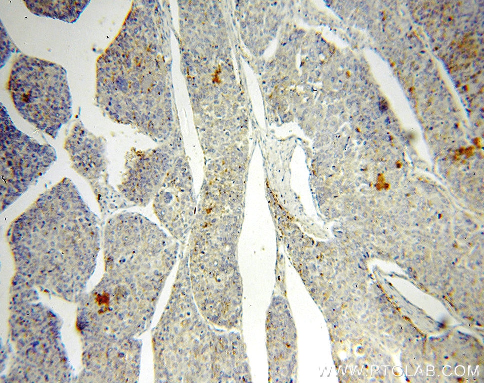 Immunohistochemistry (IHC) staining of human liver cancer tissue using RAB27A-specific Polyclonal antibody (16868-1-AP)