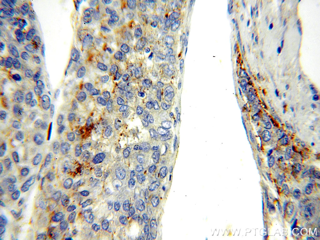 Immunohistochemistry (IHC) staining of human liver cancer tissue using RAB27A-specific Polyclonal antibody (16868-1-AP)