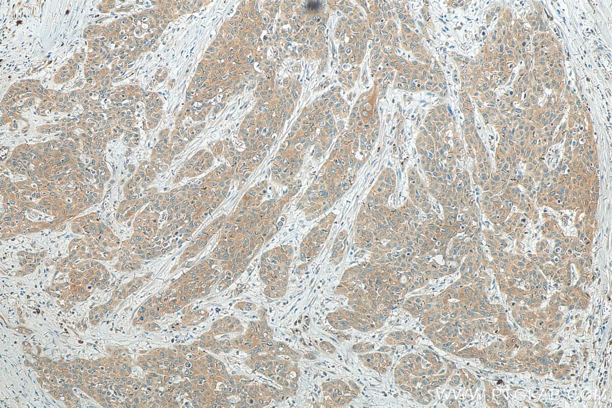 Immunohistochemistry (IHC) staining of human oesophagus cancer tissue using RAB27B Polyclonal antibody (13412-1-AP)