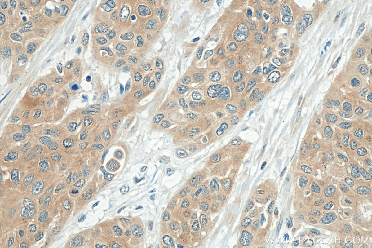 Immunohistochemistry (IHC) staining of human oesophagus cancer tissue using RAB27B Polyclonal antibody (13412-1-AP)