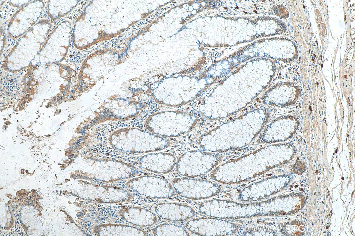 Immunohistochemistry (IHC) staining of human colon cancer tissue using RAB27B Polyclonal antibody (13412-1-AP)