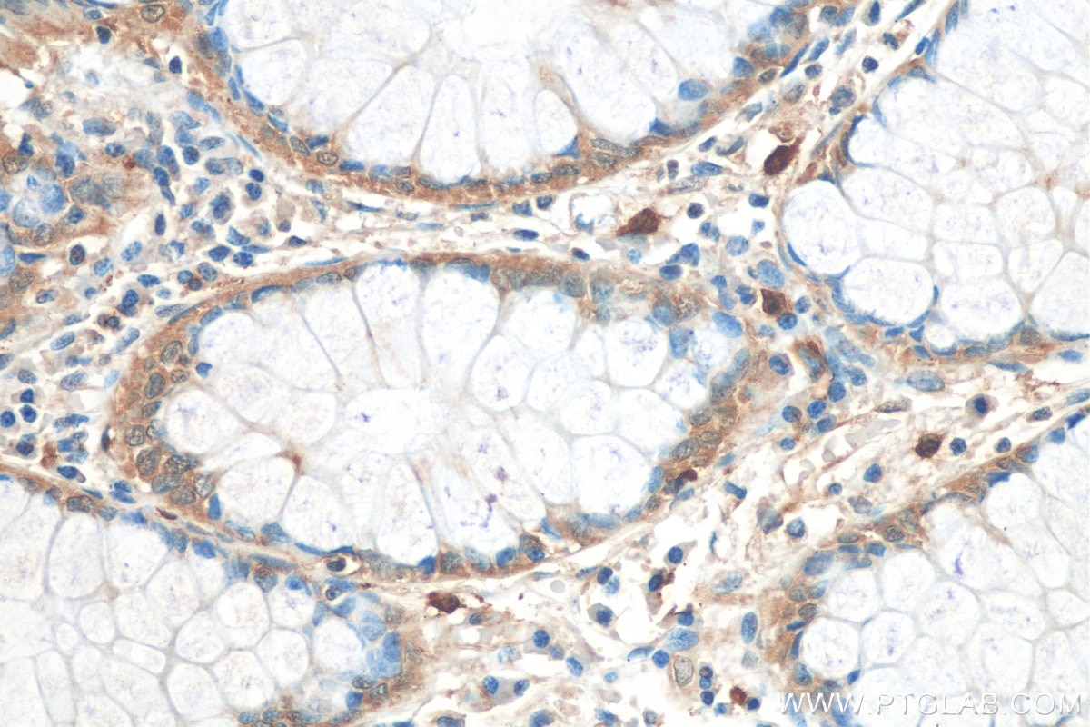 Immunohistochemistry (IHC) staining of human colon cancer tissue using RAB27B Polyclonal antibody (13412-1-AP)