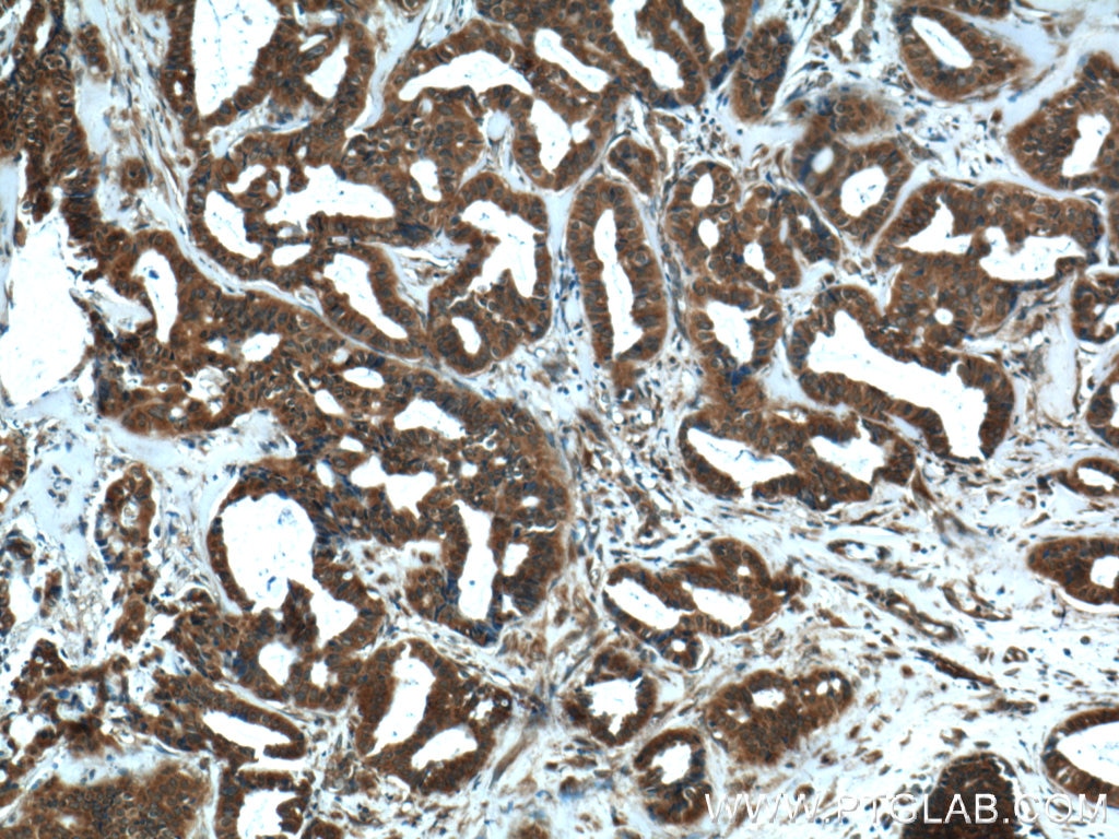 IHC staining of human breast cancer using 13412-1-AP