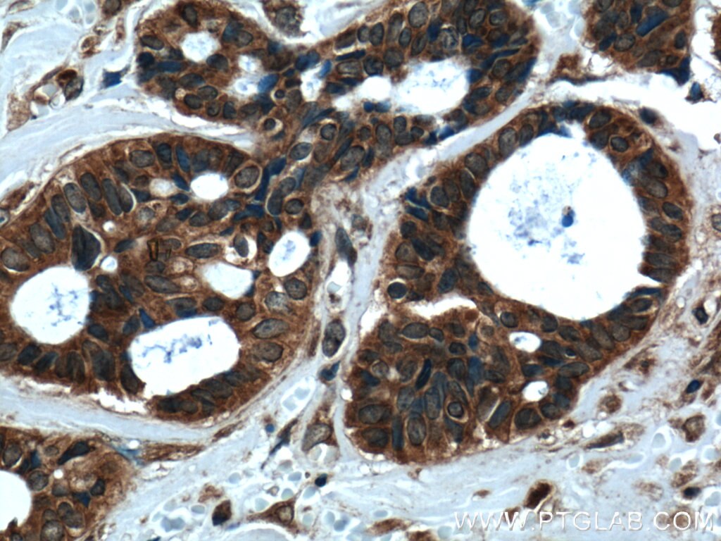 Immunohistochemistry (IHC) staining of human breast cancer tissue using RAB27B Polyclonal antibody (13412-1-AP)