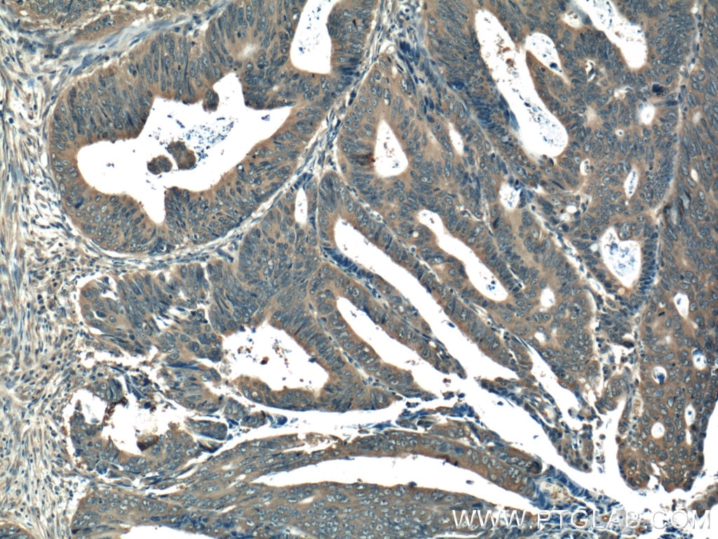 Immunohistochemistry (IHC) staining of human colon cancer tissue using RAB27B Polyclonal antibody (13412-1-AP)