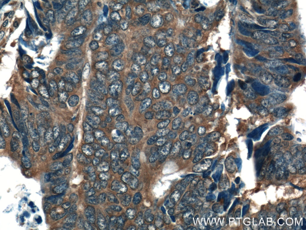 Immunohistochemistry (IHC) staining of human colon cancer tissue using RAB27B Polyclonal antibody (13412-1-AP)