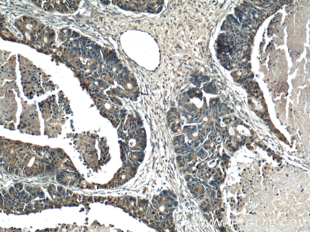 Immunohistochemistry (IHC) staining of human pancreas cancer tissue using RAB27B Polyclonal antibody (13412-1-AP)