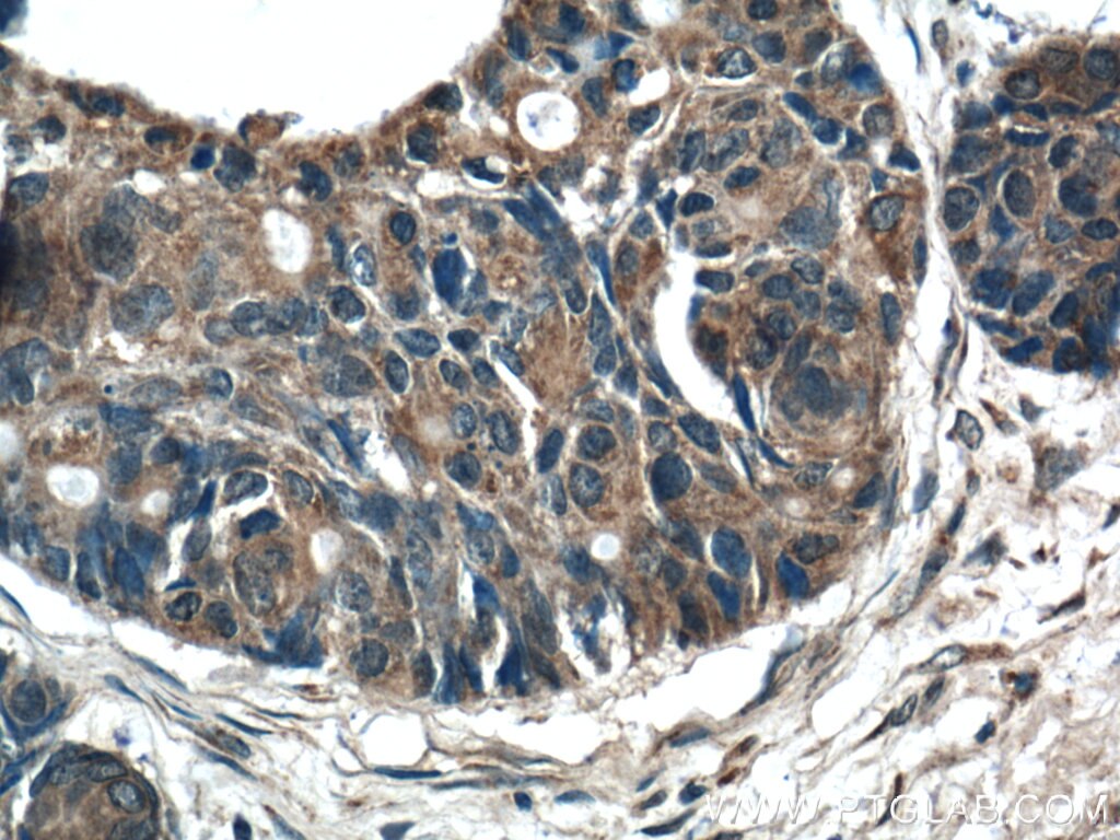 Immunohistochemistry (IHC) staining of human pancreas cancer tissue using RAB27B Polyclonal antibody (13412-1-AP)