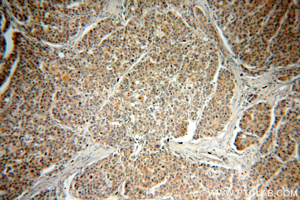 Immunohistochemistry (IHC) staining of human liver cancer tissue using RAB27B Polyclonal antibody (13412-1-AP)