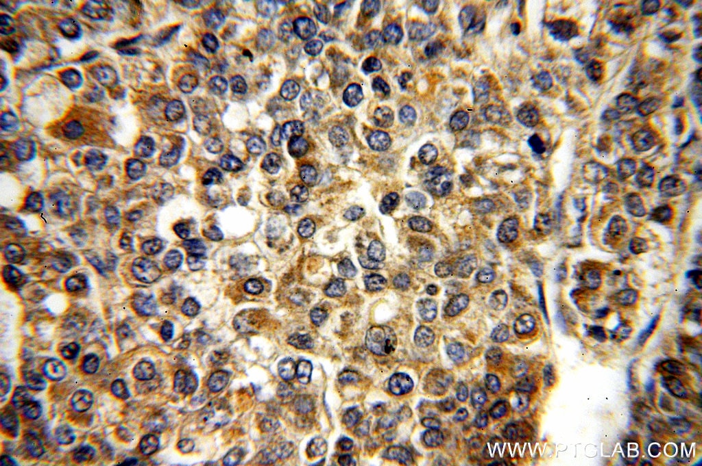 Immunohistochemistry (IHC) staining of human liver cancer tissue using RAB27B Polyclonal antibody (13412-1-AP)