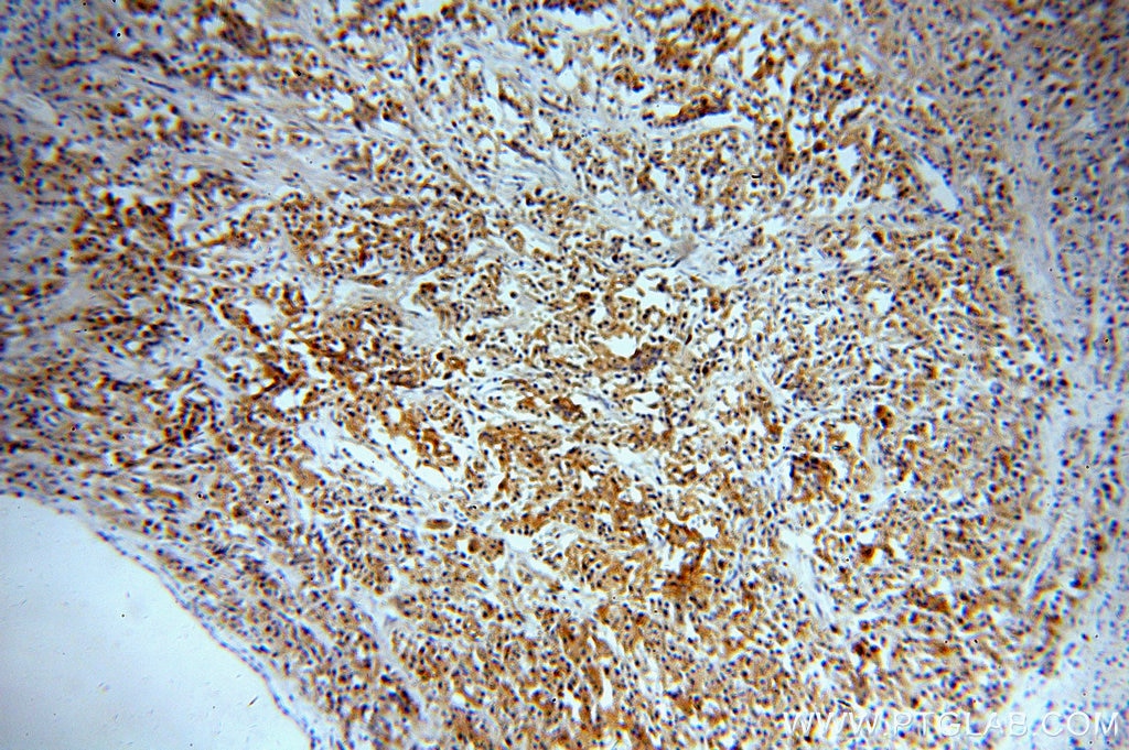 Immunohistochemistry (IHC) staining of human prostate cancer tissue using RAB27B Polyclonal antibody (13412-1-AP)