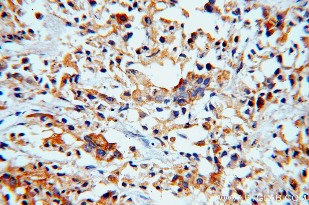 Immunohistochemistry (IHC) staining of human prostate cancer tissue using RAB27B Polyclonal antibody (13412-1-AP)