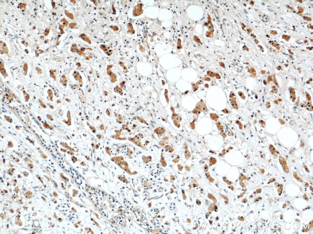 Immunohistochemistry (IHC) staining of human breast cancer tissue using RAB27B Polyclonal antibody (13412-1-AP)