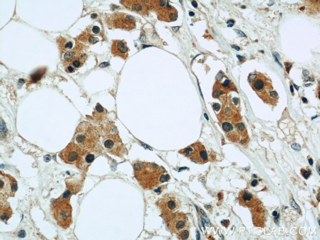 Immunohistochemistry (IHC) staining of human breast cancer tissue using RAB27B Polyclonal antibody (13412-1-AP)