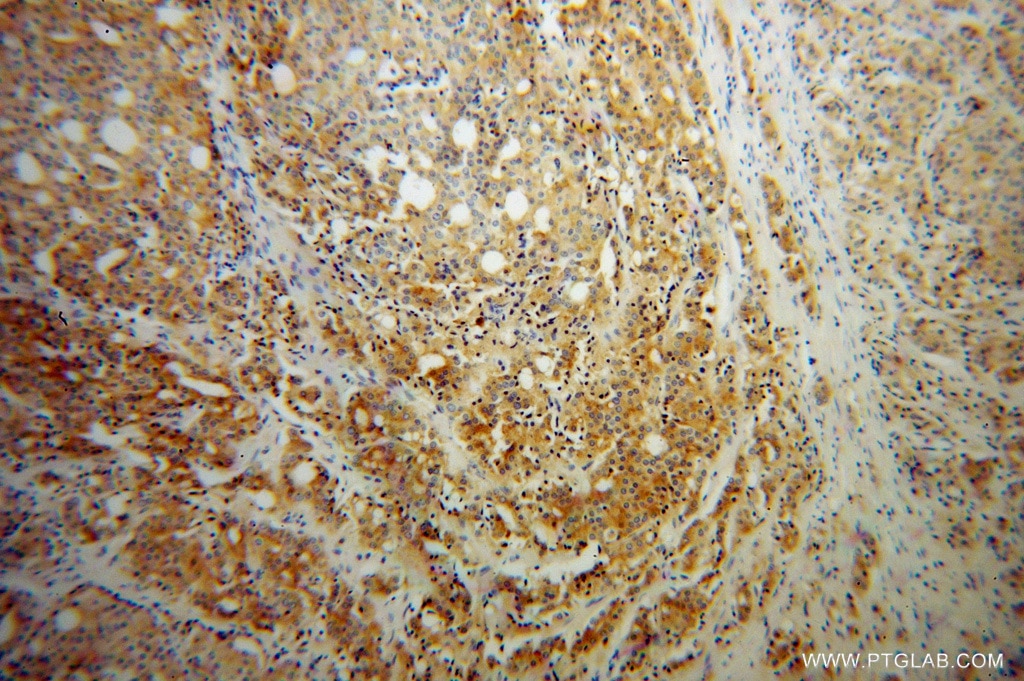 Immunohistochemistry (IHC) staining of human prostate cancer tissue using RAB27B Polyclonal antibody (13412-1-AP)