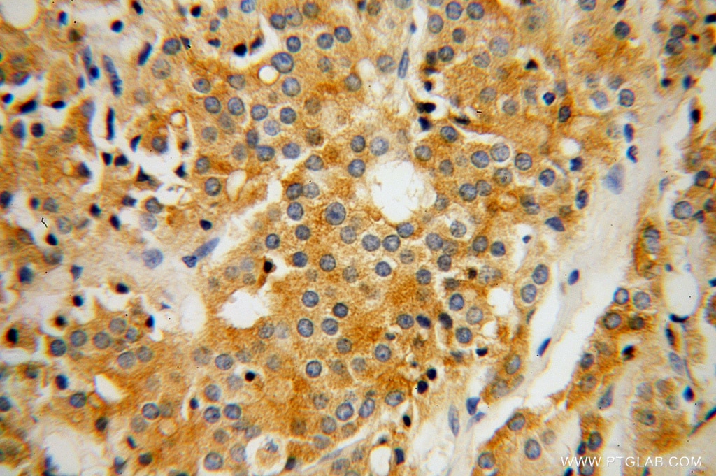 Immunohistochemistry (IHC) staining of human prostate cancer tissue using RAB27B Polyclonal antibody (13412-1-AP)