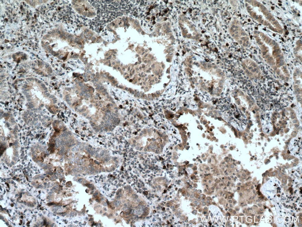 Immunohistochemistry (IHC) staining of human lung cancer tissue using RAB27B Monoclonal antibody (66944-1-Ig)