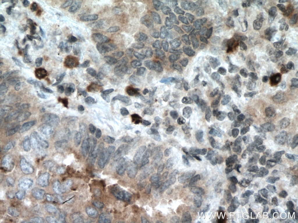 Immunohistochemistry (IHC) staining of human lung cancer tissue using RAB27B Monoclonal antibody (66944-1-Ig)