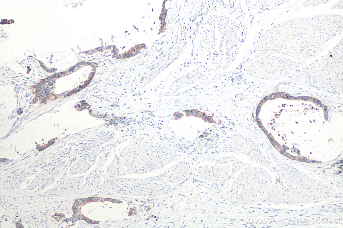 Immunohistochemistry (IHC) staining of human urothelial carcinoma tissue using RAB2A/B Polyclonal antibody (15420-1-AP)