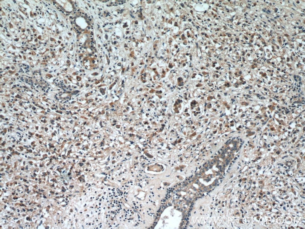 Immunohistochemistry (IHC) staining of human breast cancer tissue using RAB2 Polyclonal antibody (15420-1-AP)