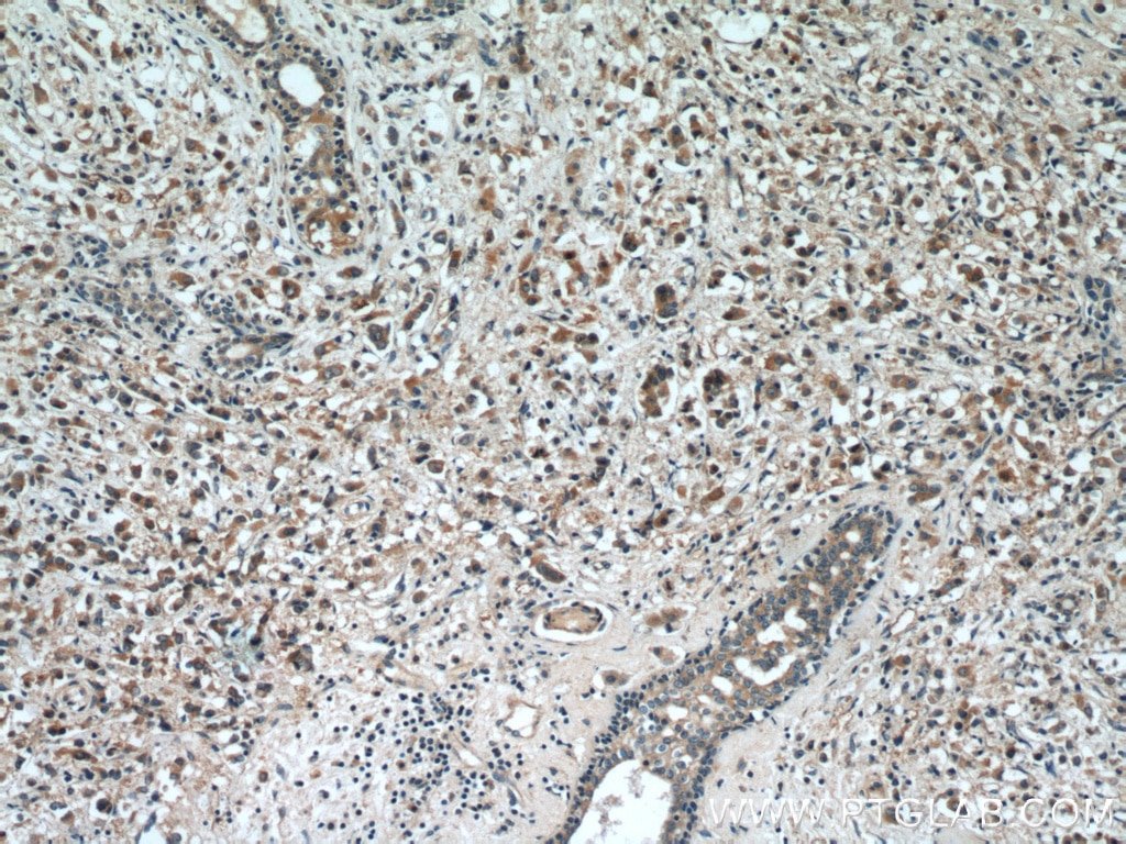 IHC staining of human breast cancer using 15420-1-AP