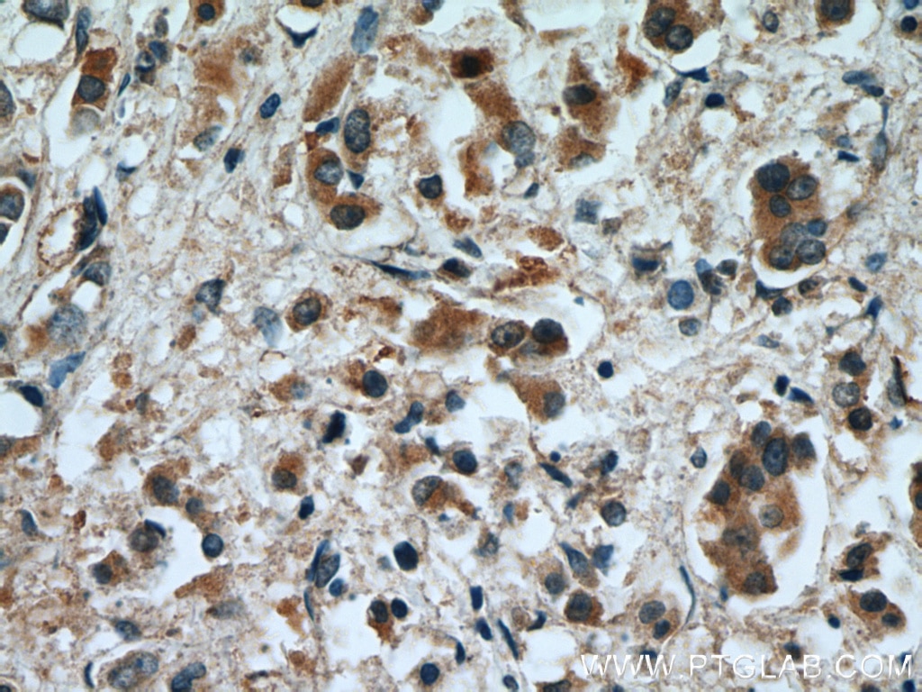 Immunohistochemistry (IHC) staining of human breast cancer tissue using RAB2 Polyclonal antibody (15420-1-AP)