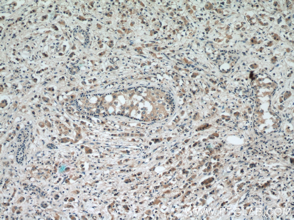 Immunohistochemistry (IHC) staining of human breast cancer tissue using RAB2 Polyclonal antibody (15420-1-AP)