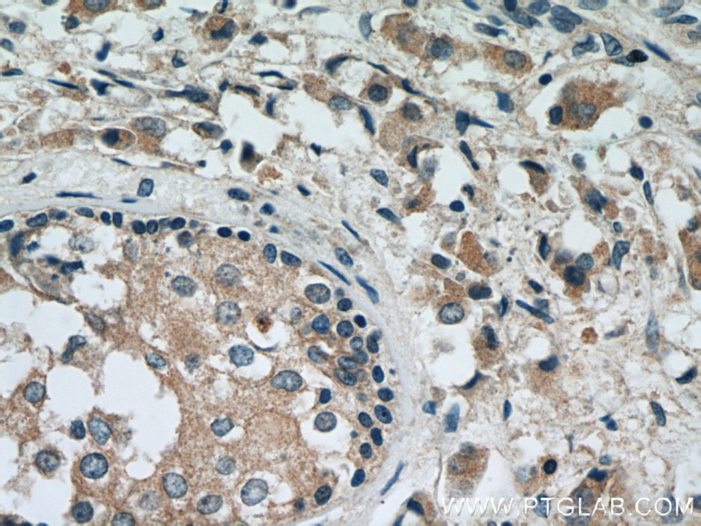 Immunohistochemistry (IHC) staining of human breast cancer tissue using RAB2 Polyclonal antibody (15420-1-AP)