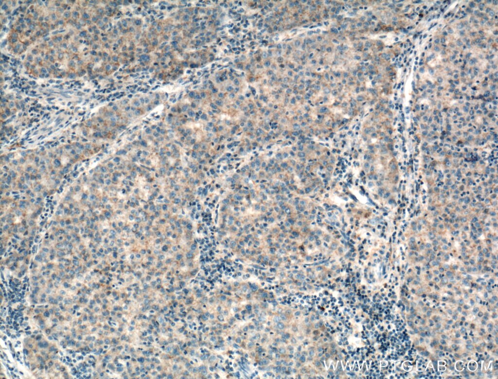 Immunohistochemistry (IHC) staining of human liver cancer tissue using RAB31 Polyclonal antibody (15485-1-AP)