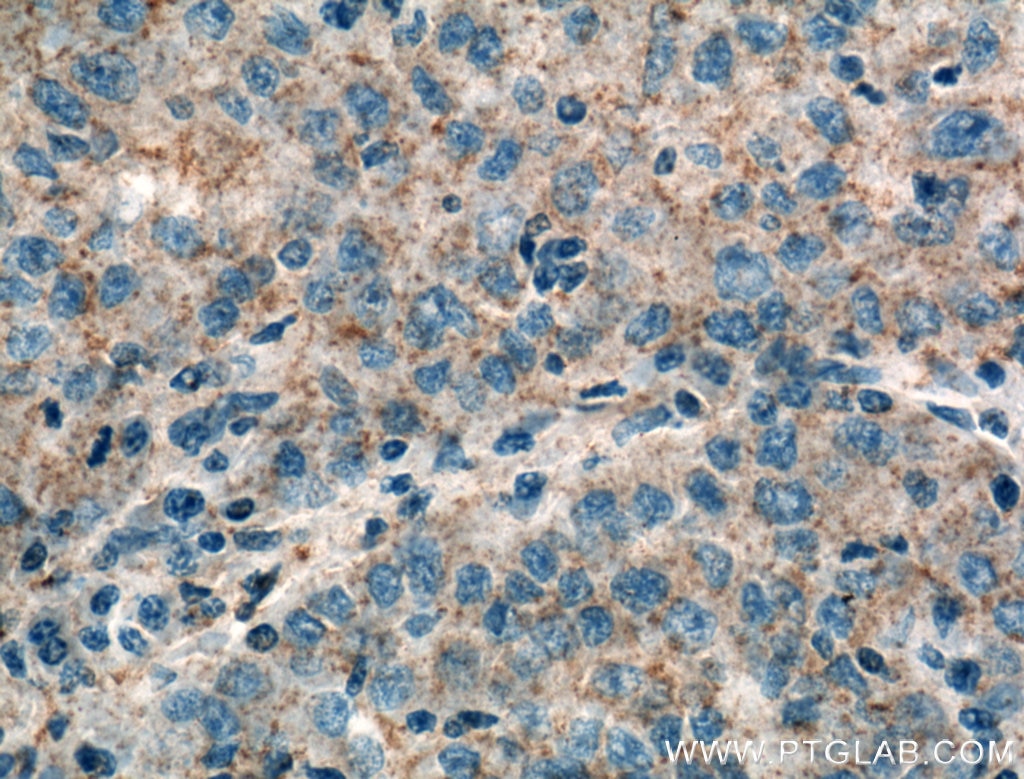 Immunohistochemistry (IHC) staining of human liver cancer tissue using RAB31 Polyclonal antibody (15485-1-AP)