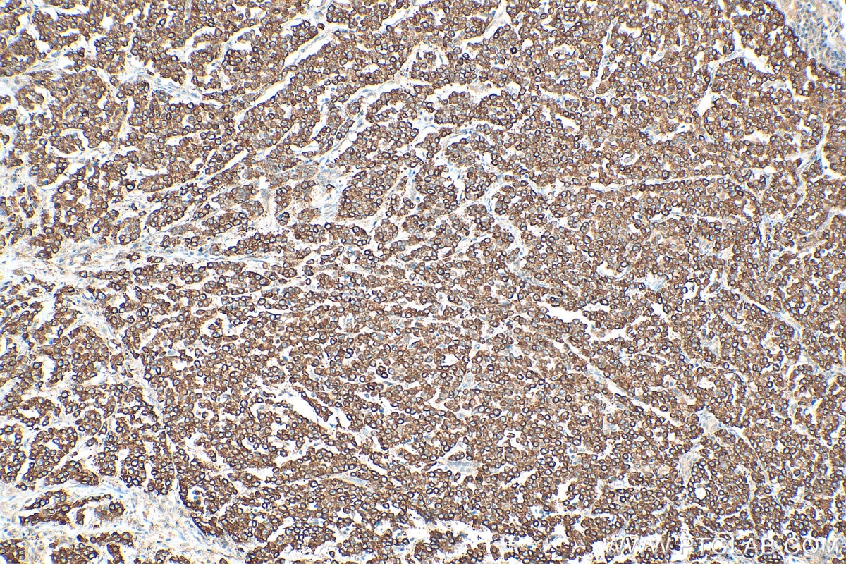 Immunohistochemical analysis of paraffin-embedded human colon cancer tissue slide using 10999-1-AP (RAB32 antibody) at dilution of 1:200 (under 10x lens). Heat mediated antigen retrieval with Tris-EDTA buffer (pH 9.0). Immunohistochemistry (IHC) staining of human colon cancer tissue using RAB32 Polyclonal antibody (10999-1-AP)