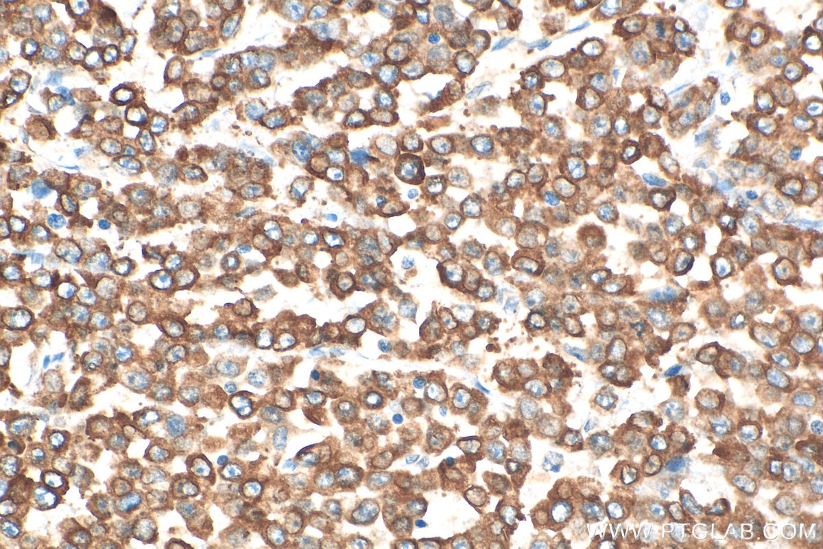 Immunohistochemical analysis of paraffin-embedded human colon cancer tissue slide using 10999-1-AP (RAB32 antibody) at dilution of 1:200 (under 40x lens). Heat mediated antigen retrieval with Tris-EDTA buffer (pH 9.0). Immunohistochemistry (IHC) staining of human colon cancer tissue using RAB32 Polyclonal antibody (10999-1-AP)