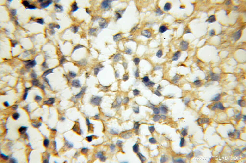 Immunohistochemistry (IHC) staining of human gliomas tissue using RAB33A Polyclonal antibody (11025-1-AP)