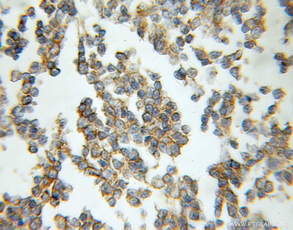 Immunohistochemistry (IHC) staining of human lymphoma tissue using RAB33A Polyclonal antibody (11025-1-AP)