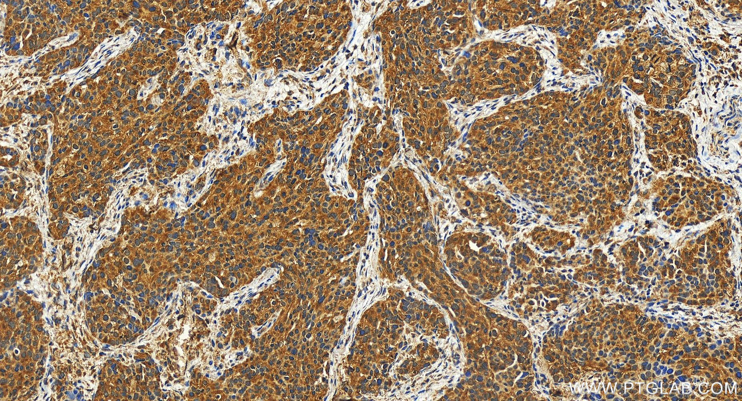 Immunohistochemistry (IHC) staining of human ovary cancer tissue using RAB34 Polyclonal antibody (27435-1-AP)