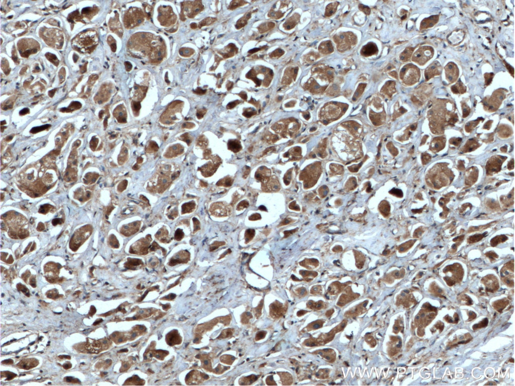 Immunohistochemistry (IHC) staining of human breast cancer tissue using RAB35 Polyclonal antibody (11329-2-AP)