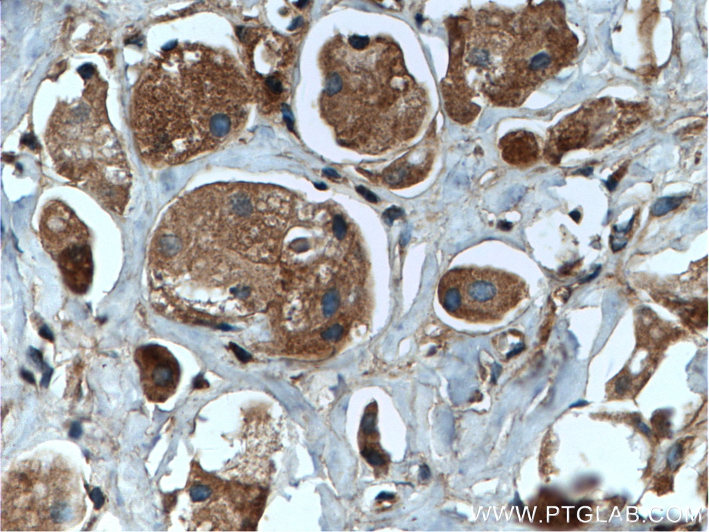 Immunohistochemistry (IHC) staining of human breast cancer tissue using RAB35 Polyclonal antibody (11329-2-AP)