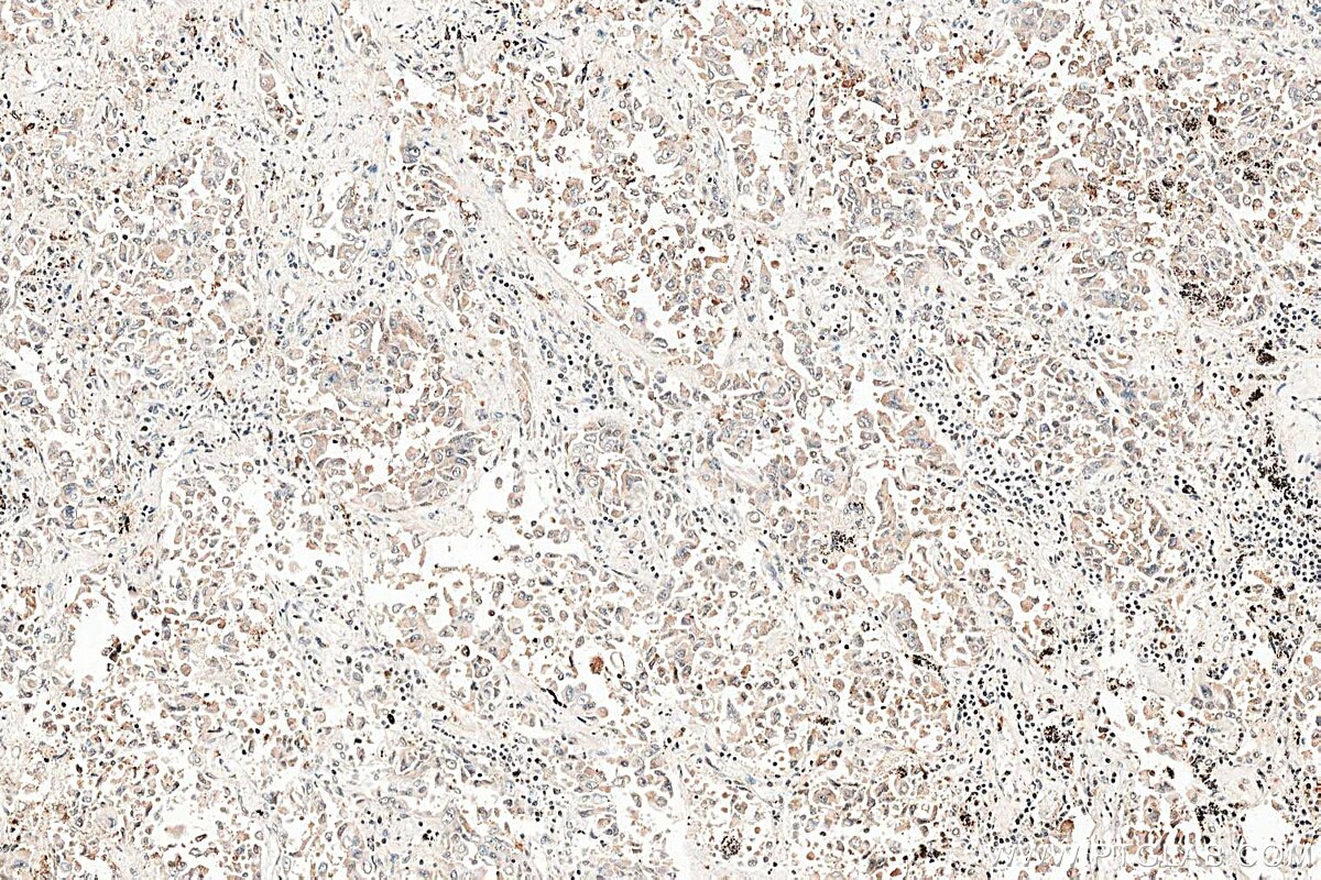 Immunohistochemistry (IHC) staining of human lung cancer tissue using RAB37 Polyclonal antibody (13051-1-AP)