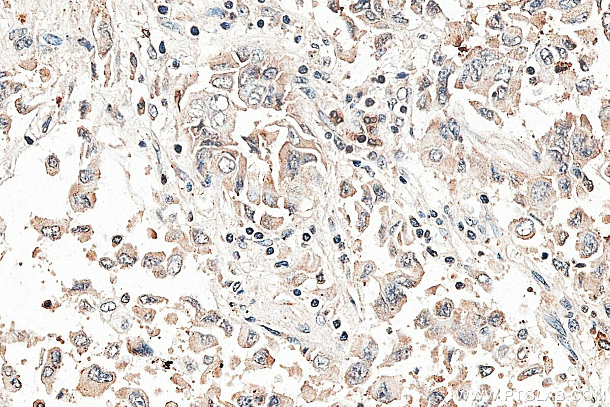 Immunohistochemistry (IHC) staining of human lung cancer tissue using RAB37 Polyclonal antibody (13051-1-AP)