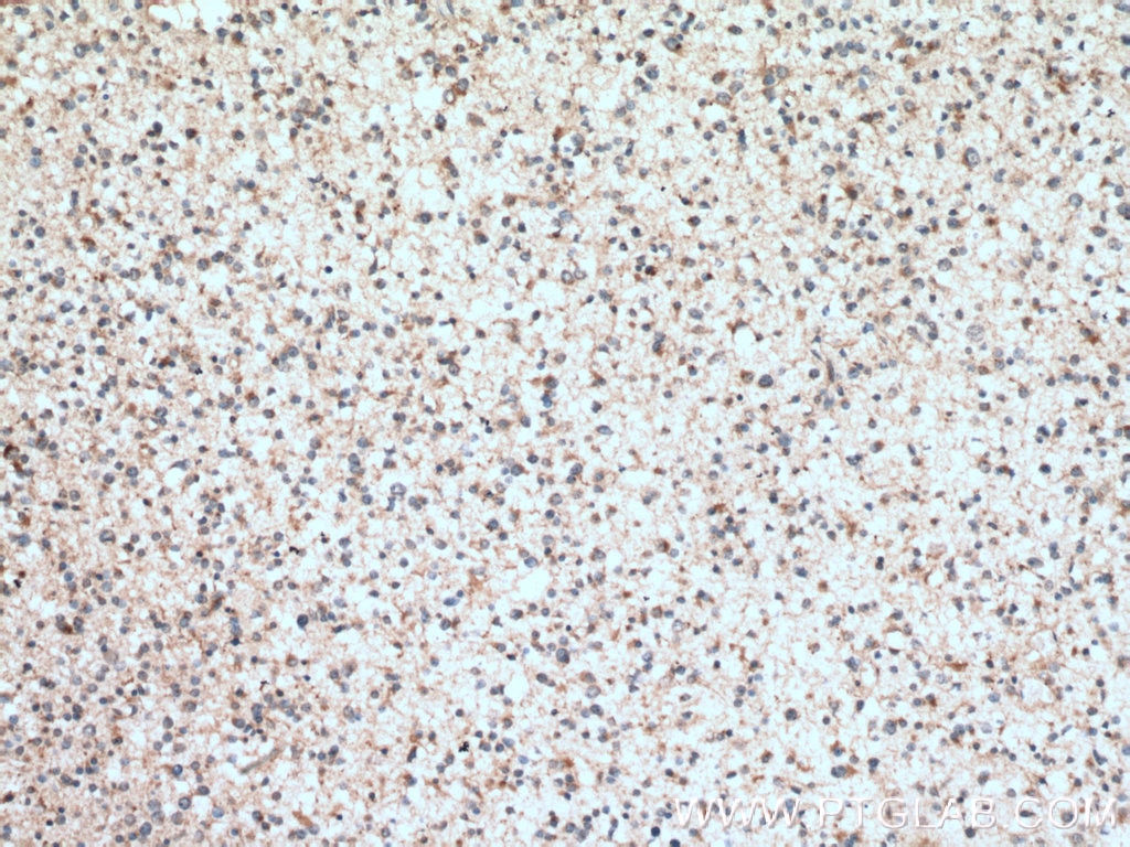 IHC staining of human gliomas using 12234-1-AP