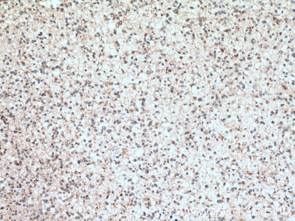 Immunohistochemistry (IHC) staining of human gliomas tissue using RAB38 Polyclonal antibody (12234-1-AP)