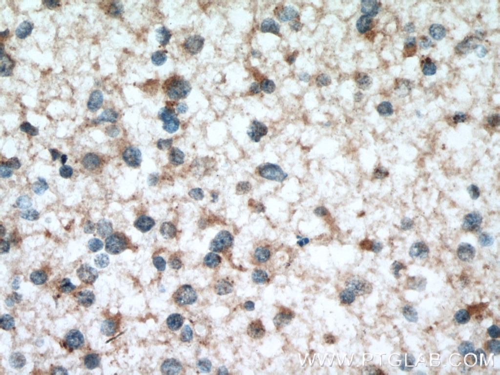 Immunohistochemistry (IHC) staining of human gliomas tissue using RAB38 Polyclonal antibody (12234-1-AP)