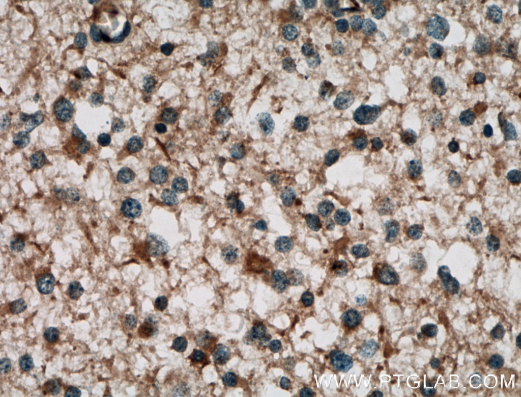 Immunohistochemistry (IHC) staining of human gliomas tissue using RAB39 Polyclonal antibody (13355-1-AP)