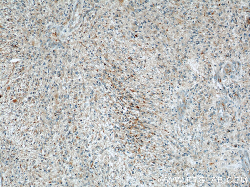 Immunohistochemistry (IHC) staining of human gliomas tissue using RAB39 Polyclonal antibody (13355-1-AP)