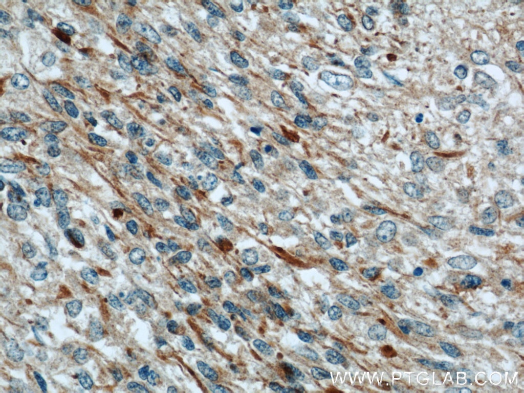 Immunohistochemistry (IHC) staining of human gliomas tissue using RAB39 Polyclonal antibody (13355-1-AP)