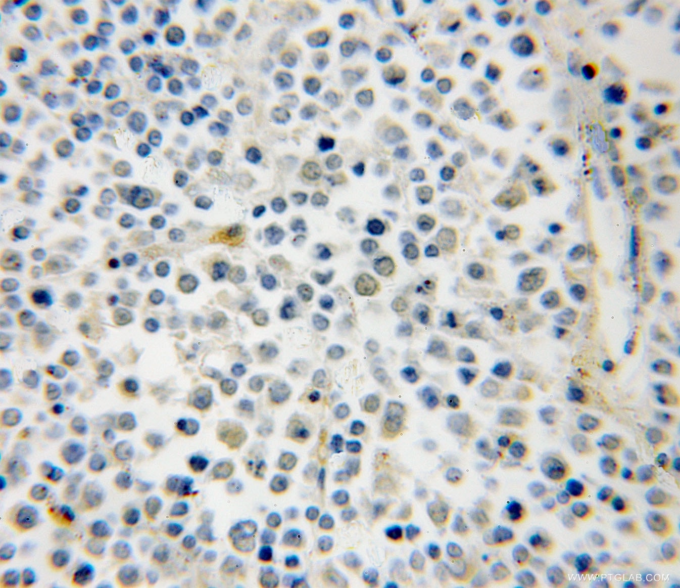 Immunohistochemistry (IHC) staining of human lymphoma tissue using RAB39B Polyclonal antibody (12162-1-AP)