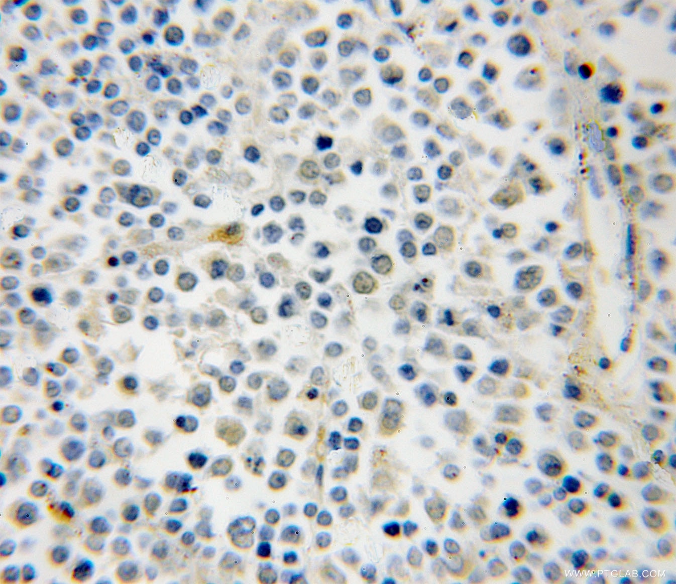 Immunohistochemistry (IHC) staining of human lymphoma tissue using RAB39B Polyclonal antibody (12162-1-AP)