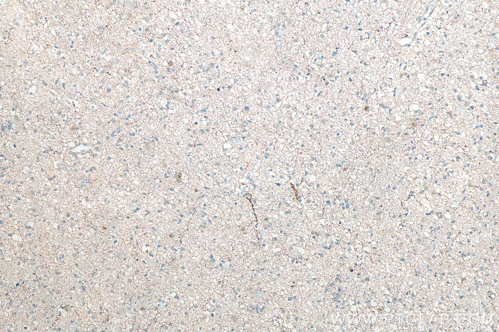 Immunohistochemistry (IHC) staining of human gliomas tissue using RAB3A Polyclonal antibody (15029-1-AP)